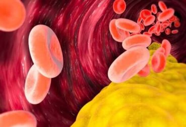 Ist VLDL-Cholesterin schädlich?