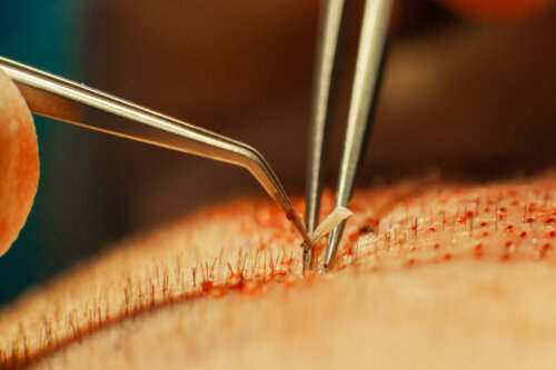 Haartransplantation