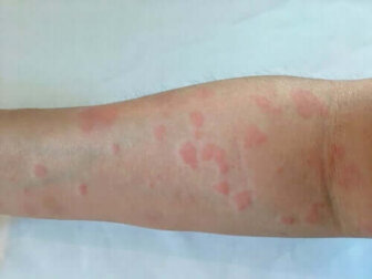 Häufig gestellte Fragen zu Lupus