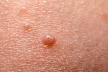 Molluscum contagiosum: Alles Wissenswerte über "Dellwarzen"