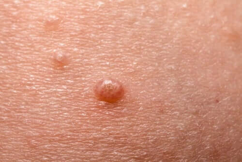 Molluscum contagiosum: Alles Wissenswerte über "Dellwarzen"
