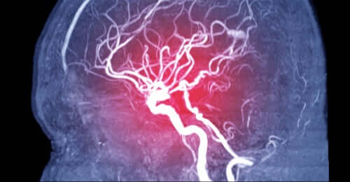 Zerebrale Embolie: Symptome, Arten und Ursachen