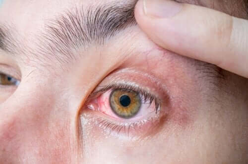 Augenmelanom: Symptome und Ursachen