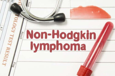 Non-Hodgkin-Lymphom (NHL): Alles, was du wissen musst