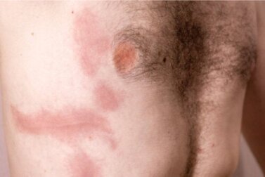 Rippenprellung: Ursachen, Symptome und Behandlung