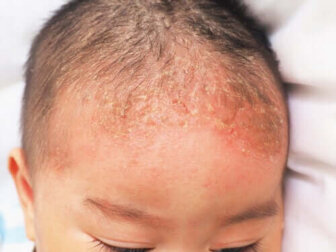 Seborrhoische Dermatitis bei Säuglingen