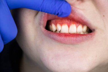 Skorbut: Symptome und Behandlung