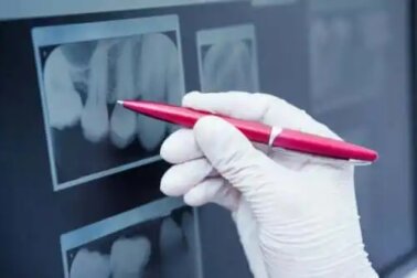 Zahnschmelz-Hypoplasie: Bedeutung und Behandlung