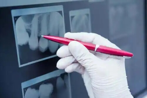 Zahnschmelz-Hypoplasie: Bedeutung und Behandlung