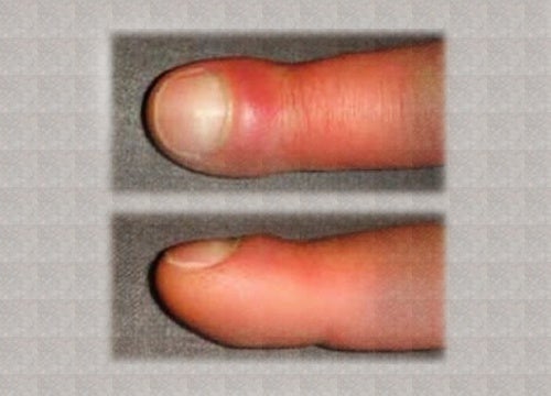 Hast du geschwollene Finger? Hier sind die möglichen Ursachen!
