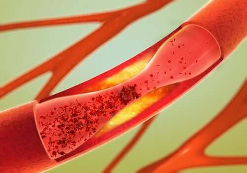Arteriosklerose oder Arterienverkalkung: Was ist das?