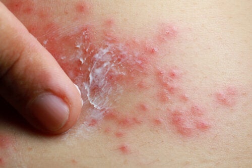Behandlung von Schuppenflechte mit TCM: Ist das möglich?