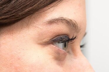 Augenringe: Ursachen und natürliche Behandlung