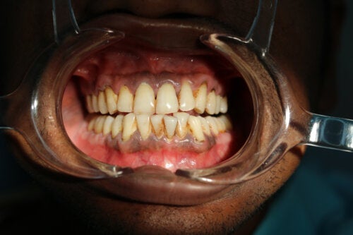 Schwarze Flecken auf dem Zahnfleisch: Ursachen und Behandlungen