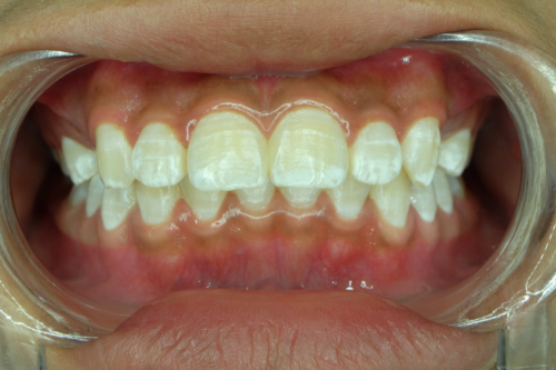 Weiße Flecken auf den Zähnen: Warum treten sie auf?