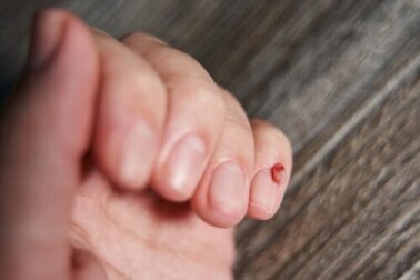 Nageltumore: Daran erkennst du sie