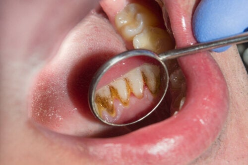 Schwarzer Zahnstein: Ursachen, Behandlung und PrÃ¤vention