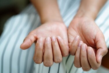Nagelrillen: Was sind die Ursachen?