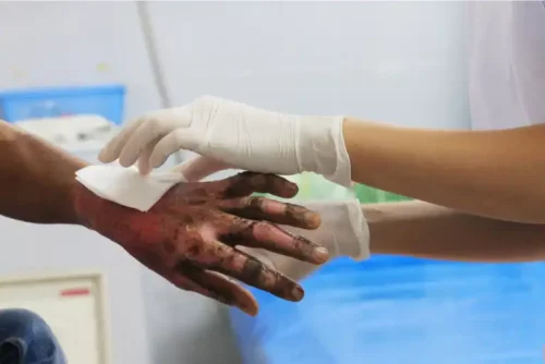 Hauttransplantation - Mensch mit Brandverletzung