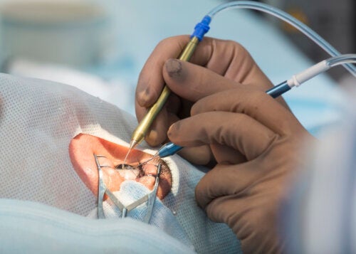 8 mögliche Komplikationen der Kataraktoperation, die du kennen solltest