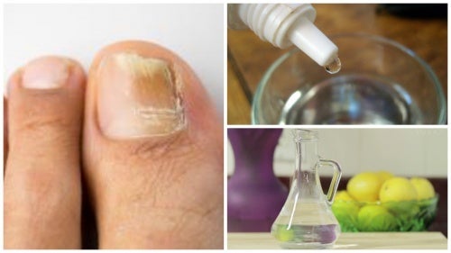 Ein Naturheilmittel gegen Nagelpilz zum Selbermachen