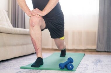 Regelmäßige Bewegung hat bei Schuppenflechte Vorteile