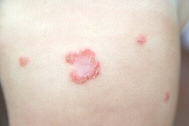 Impetigo bei Kindern