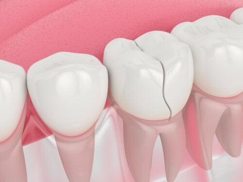 Zahnfissuren: Ursachen und Behandlung