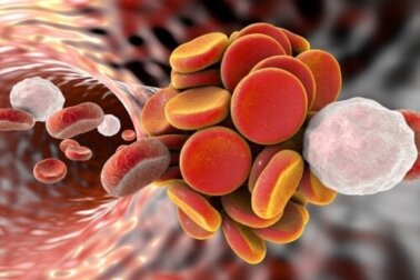Antiphospholipid-Syndrom (APS): Ursachen, Symptome und Behandlungen