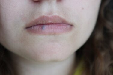 Lippenkrebs: Ursachen, Symptome und Behandlungsoptionen