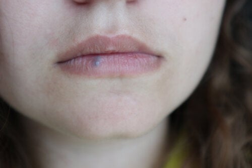 Lippenkrebs: Ursachen, Symptome und Behandlungsoptionen