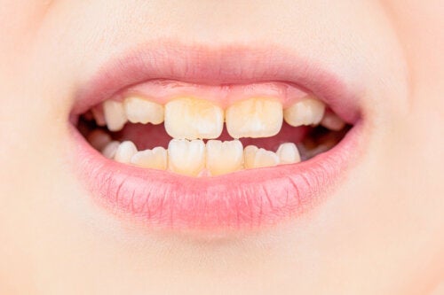 Amelogenesis Imperfecta oder angeborene Zahnschmelzhypoplasie