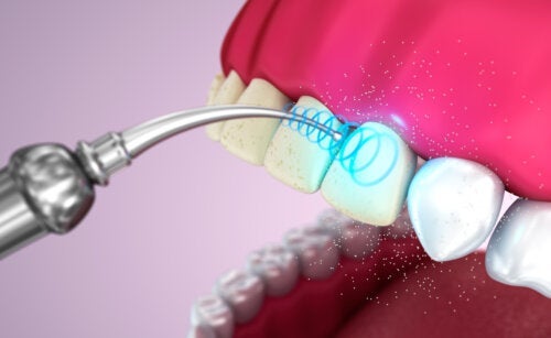 Ultraschall-Zahnreinigung: Die Vor- und Nachteile