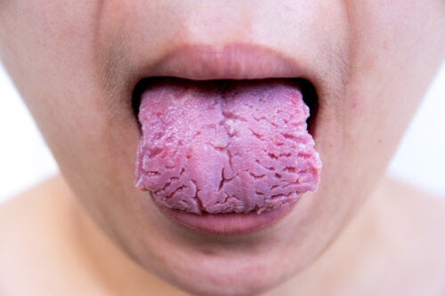 Rissige Zunge: Ursachen und Behandlung