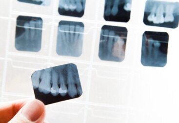 Was ist dentale Ankylose und wie kann sie behandelt werden?