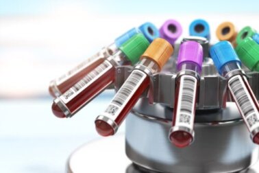 Neuer Bluttest zur Tumorerkennung vor dem Auftreten von Symptomen