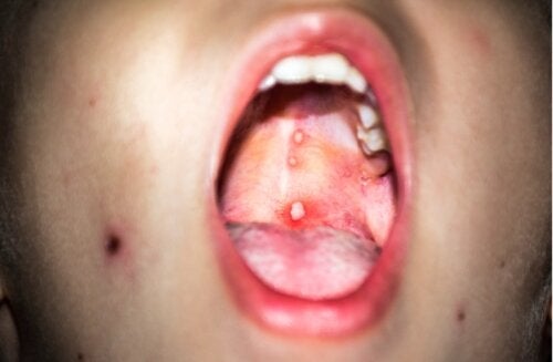Gingivostomatitis bei Kindern: Was ist das und was kann man dagegen tun?