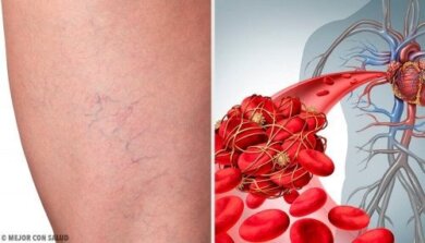 Die 3 besten Hausmittel bei Phlebitis