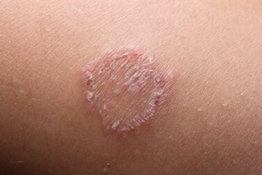 Was ist Tinea corporis oder Ringelflechte und wie behandelst du sie?