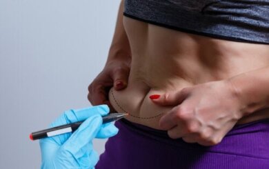 BodyTite, die Technologie zur Verringerung der Körperschlaffheit