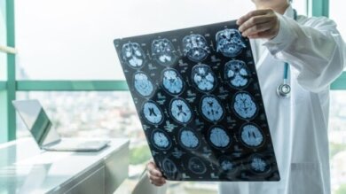 Was ist eine Stroke Unit?