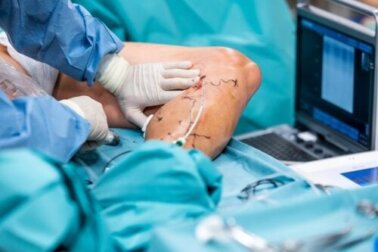 Behandlung von Krampfadern mit Endolaser