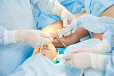 Sklerotherapie bei Krampfadern: Wie wird sie durchgeführt?