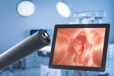 Die Antirefluxoperation zur Behandlung der gastroösophagealen Refluxkrankheit