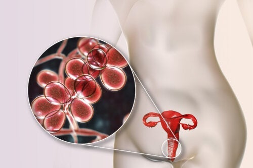 Gelber Vaginalausfluss: 5 Ursachen und Behandlung