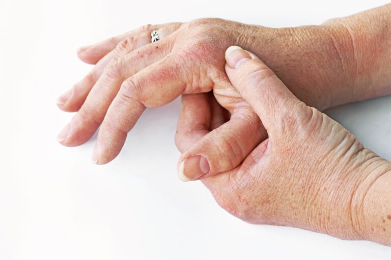 Neurodermitis erkennen und richtig behandeln