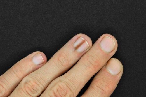 Melanonychie: dunkle Nagelverfärbung