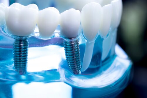 Zahnsanierung: Schöne Zähne durch Zahnimplantate