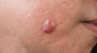 Pusteln: Entstehung und Behandlung